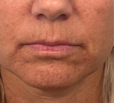 Lip Filler Before & After Gallery - Patient 397601 - Image 1