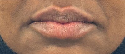 Lip Filler Before & After Gallery - Patient 269222 - Image 2