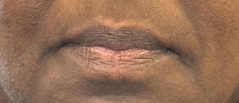 Lip Filler Before & After Gallery - Patient 269222 - Image 1