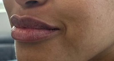 Lip Filler Before & After Gallery - Patient 143061 - Image 2
