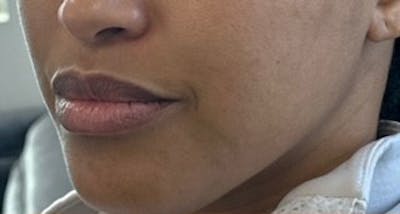 Lip Filler Before & After Gallery - Patient 143061 - Image 1