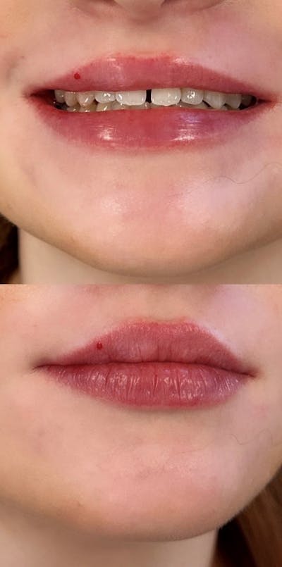 Lip Filler Before & After Gallery - Patient 421489 - Image 2