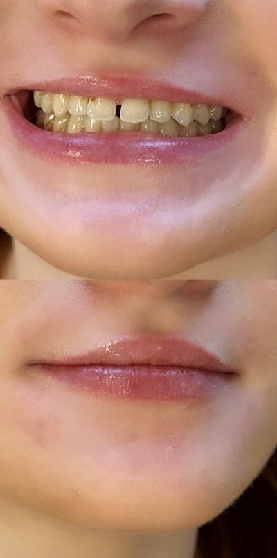 Lip Filler Before & After Gallery - Patient 421489 - Image 1