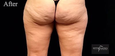 CoolSculpting® Before & After Gallery - Patient 876594 - Image 2