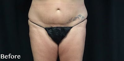 CoolSculpting® Before & After Gallery - Patient 186372 - Image 1