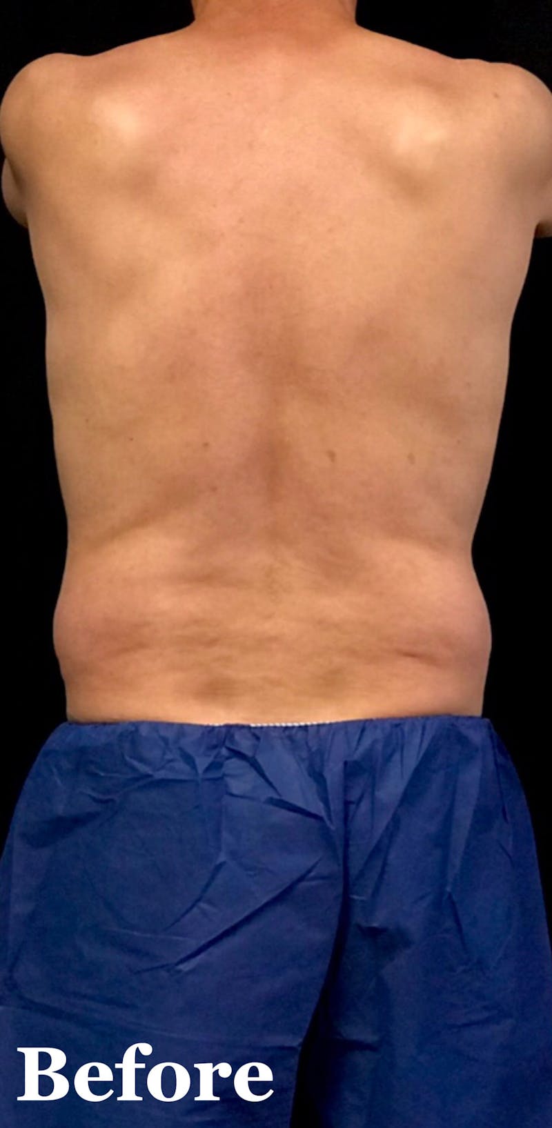 CoolSculpting® Before & After Gallery - Patient 784907 - Image 1