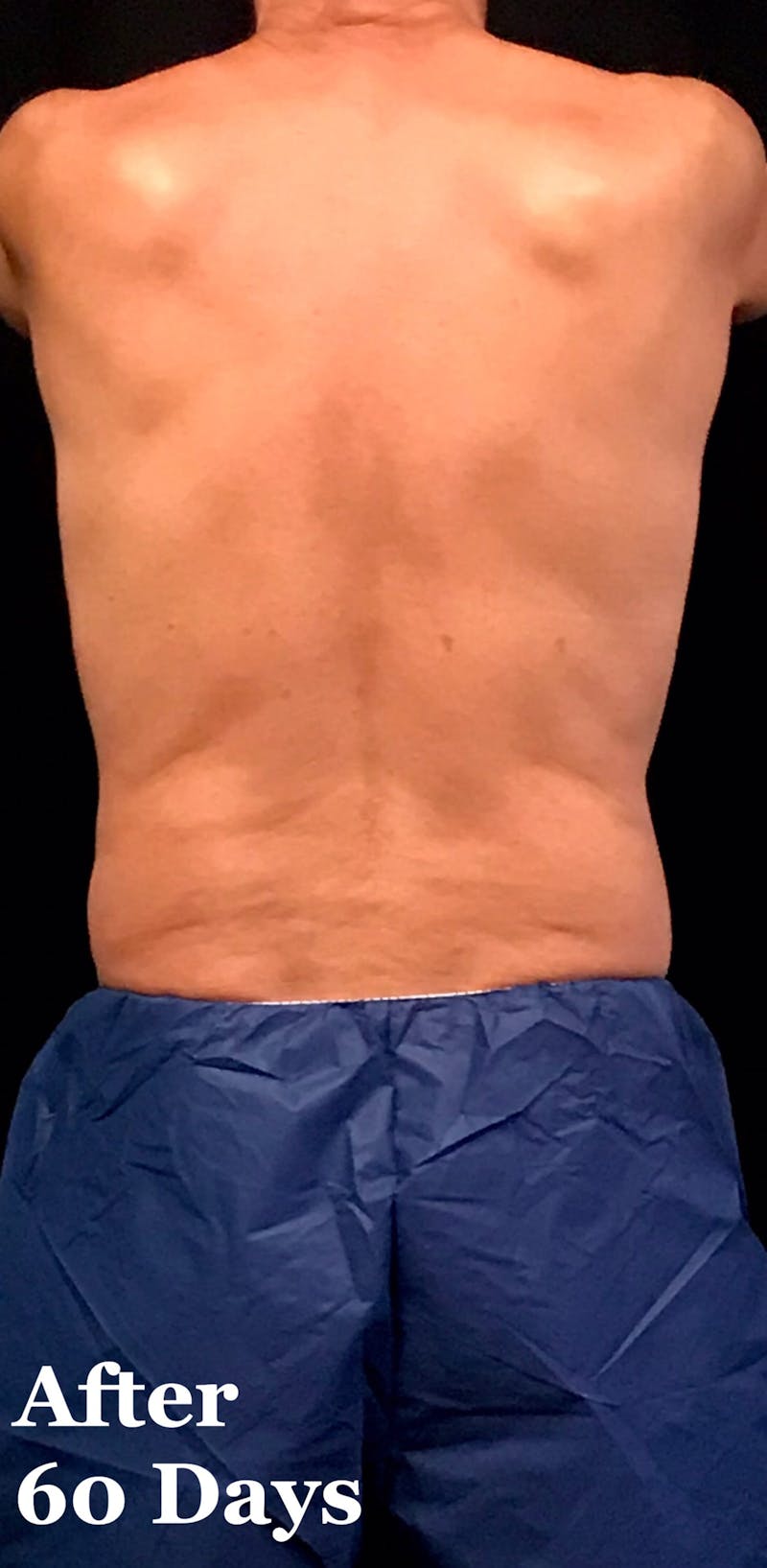 CoolSculpting® Before & After Gallery - Patient 784907 - Image 2