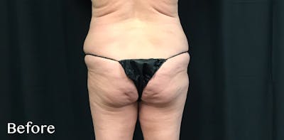 CoolSculpting® Before & After Gallery - Patient 592498 - Image 1