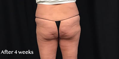 CoolSculpting® Before & After Gallery - Patient 592498 - Image 2