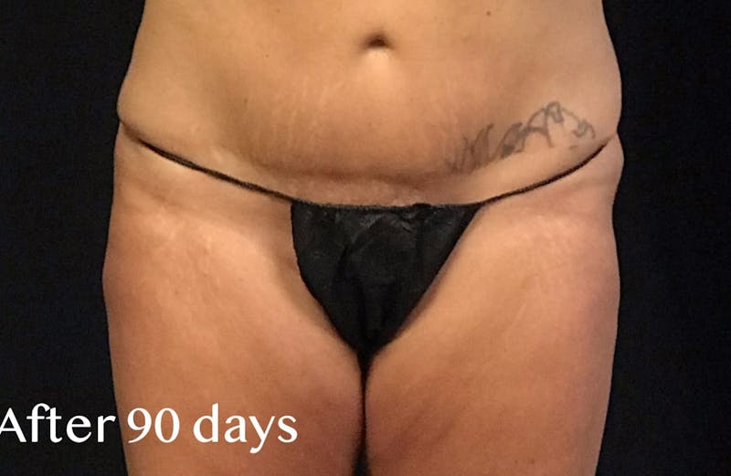 CoolSculpting® Before & After Gallery - Patient 120413 - Image 1