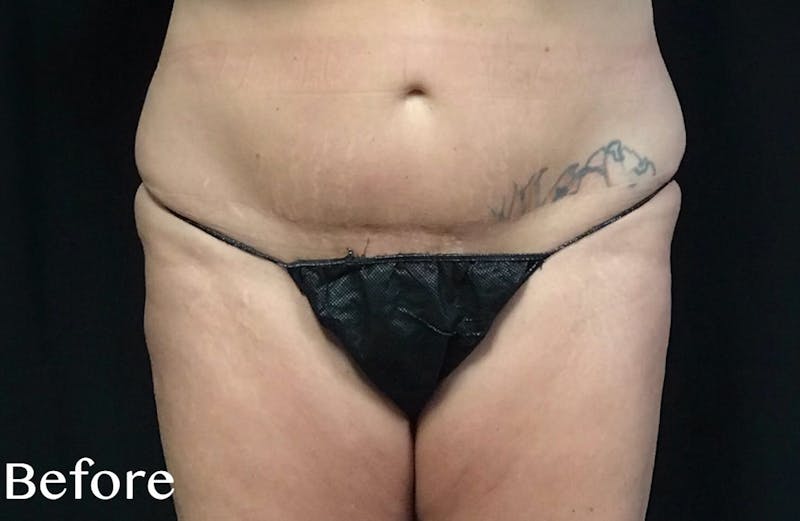 CoolSculpting® Before & After Gallery - Patient 120413 - Image 2