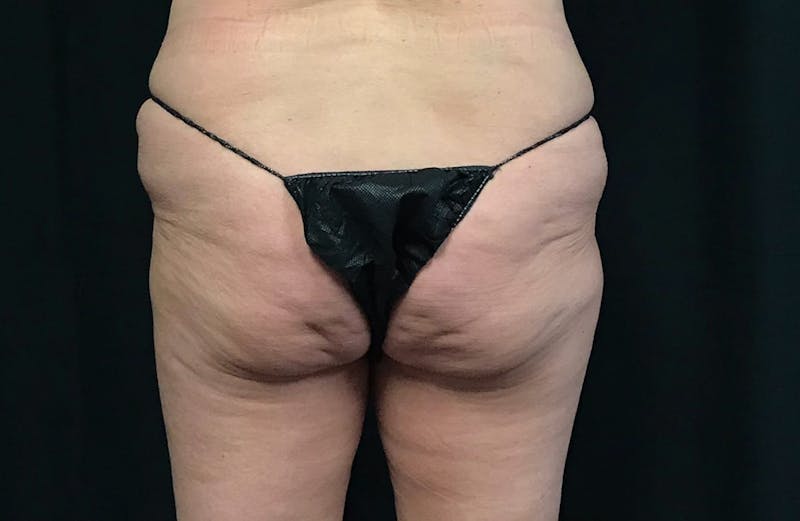 CoolSculpting® Before & After Gallery - Patient 120413 - Image 3