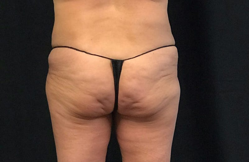 CoolSculpting® Before & After Gallery - Patient 120413 - Image 4