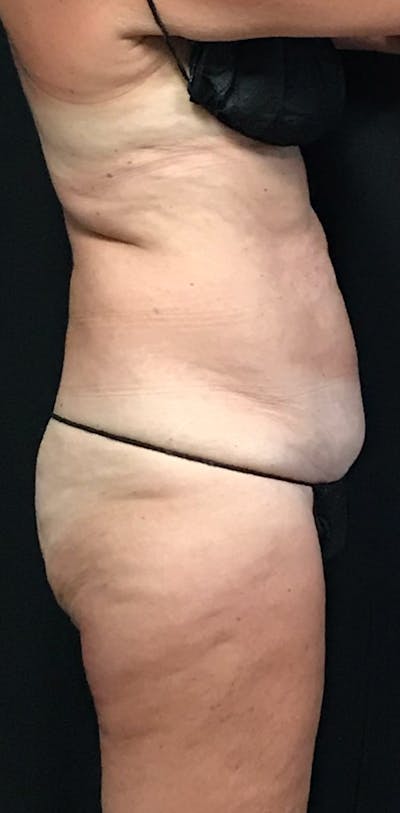 CoolSculpting® Before & After Gallery - Patient 230051 - Image 1