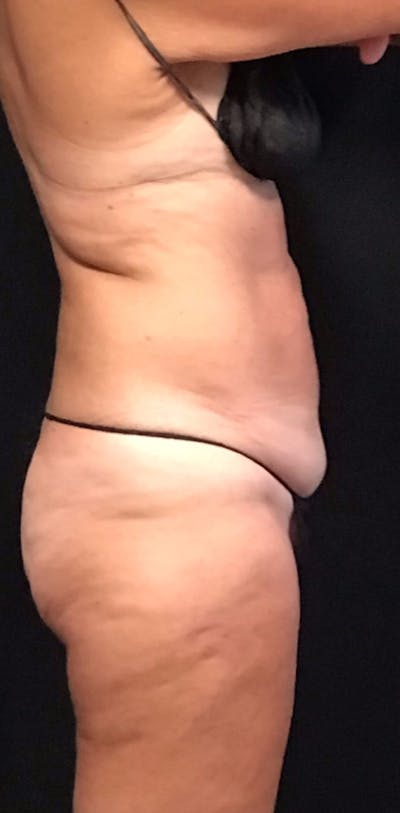 CoolSculpting® Before & After Gallery - Patient 230051 - Image 2