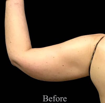 CoolSculpting® Before & After Gallery - Patient 123785 - Image 1