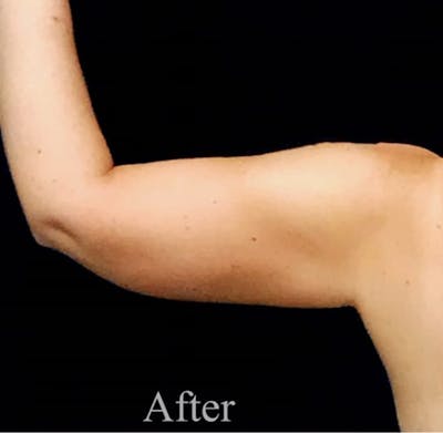 CoolSculpting® Before & After Gallery - Patient 123785 - Image 2