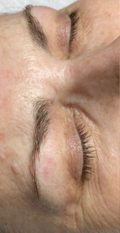Eyebrow Microblading Before & After Gallery - Patient 282650 - Image 1