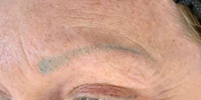 Eyebrow Microblading Before & After Gallery - Patient 333019 - Image 1