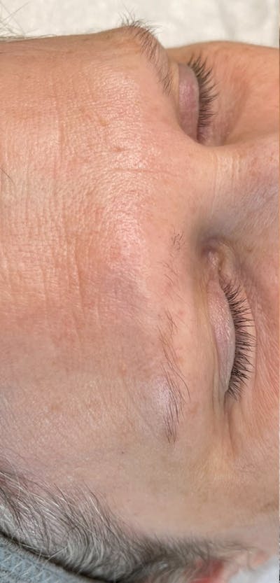 Eyebrow Microblading Before & After Gallery - Patient 206068 - Image 1