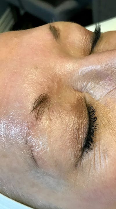 Eyebrow Microblading Before & After Gallery - Patient 347466 - Image 1