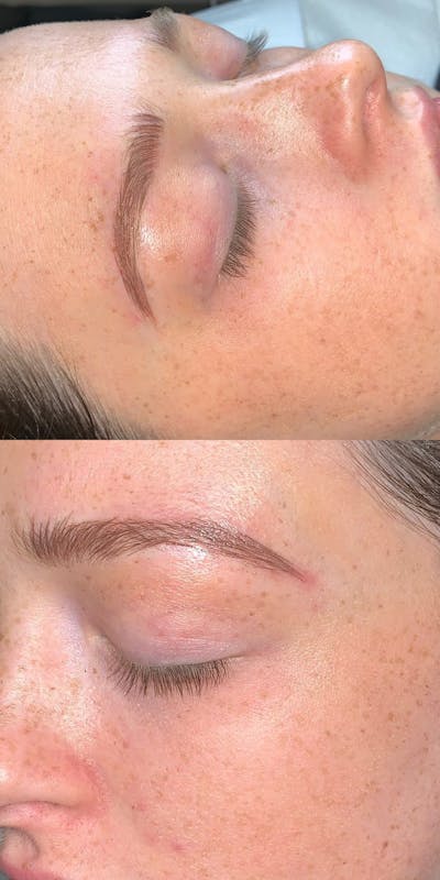 Eyebrow Microblading Before & After Gallery - Patient 234880 - Image 1