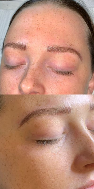 Eyebrow Microblading Before & After Gallery - Patient 234880 - Image 2