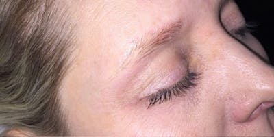 Eyebrow Microblading Before & After Gallery - Patient 187512 - Image 1