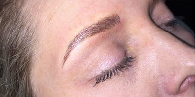 Eyebrow Microblading Before & After Gallery - Patient 187512 - Image 2