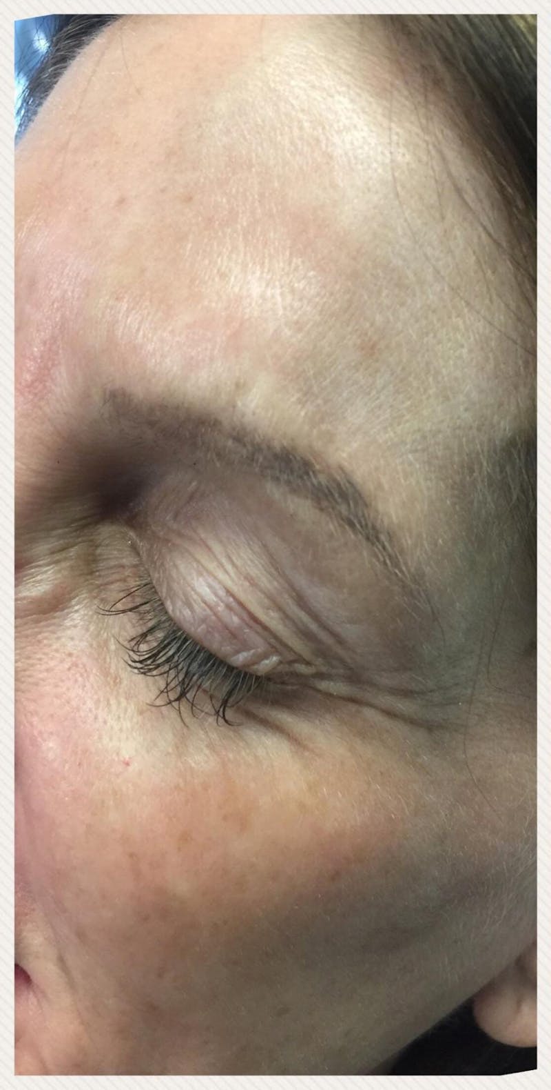 Eyebrow Microblading Before & After Gallery - Patient 199752 - Image 1