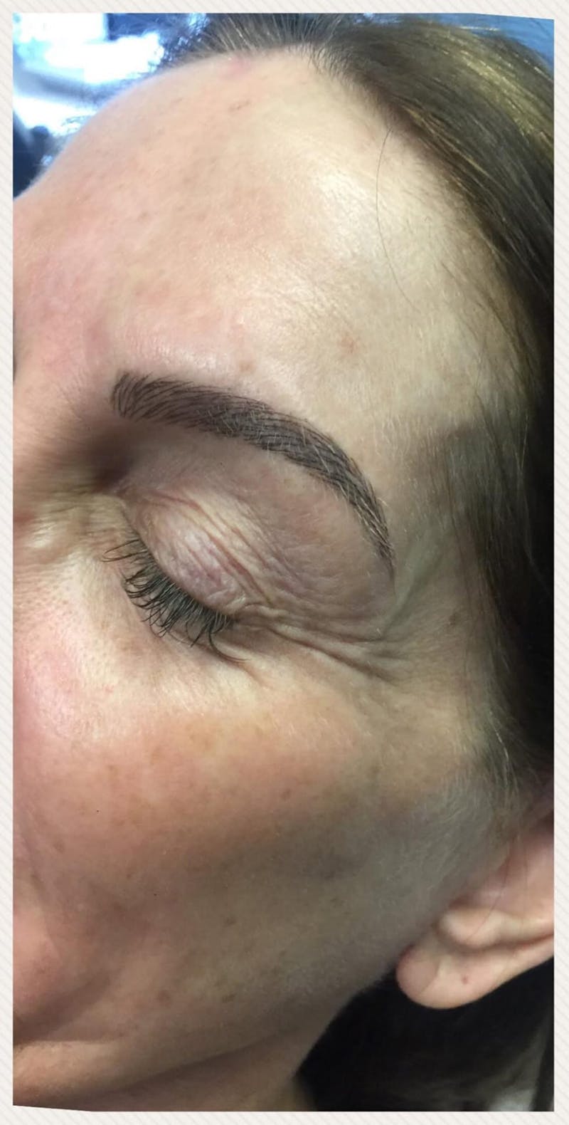Eyebrow Microblading Before & After Gallery - Patient 199752 - Image 2