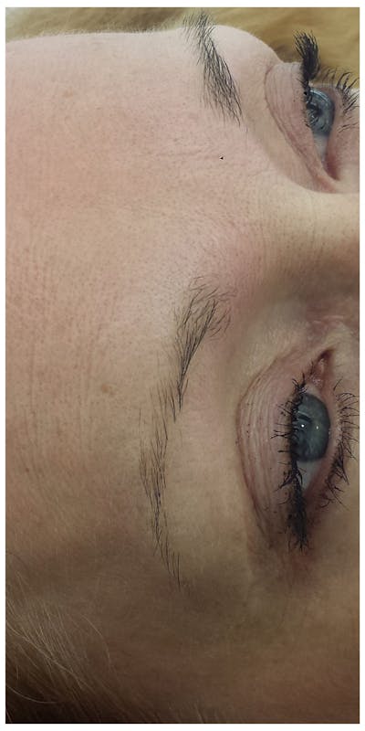 Eyebrow Microblading Before & After Gallery - Patient 359122 - Image 1