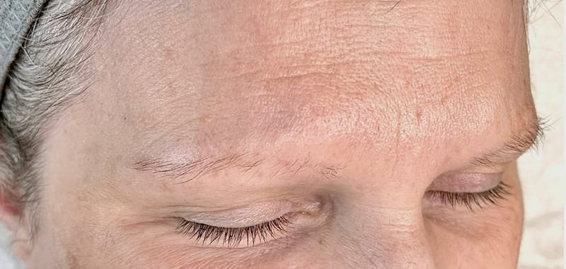Eyebrow Microblading Before & After Gallery - Patient 899141 - Image 1