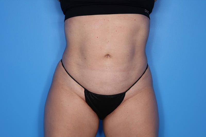 Liposuction Before & After Gallery - Patient 150098 - Image 2
