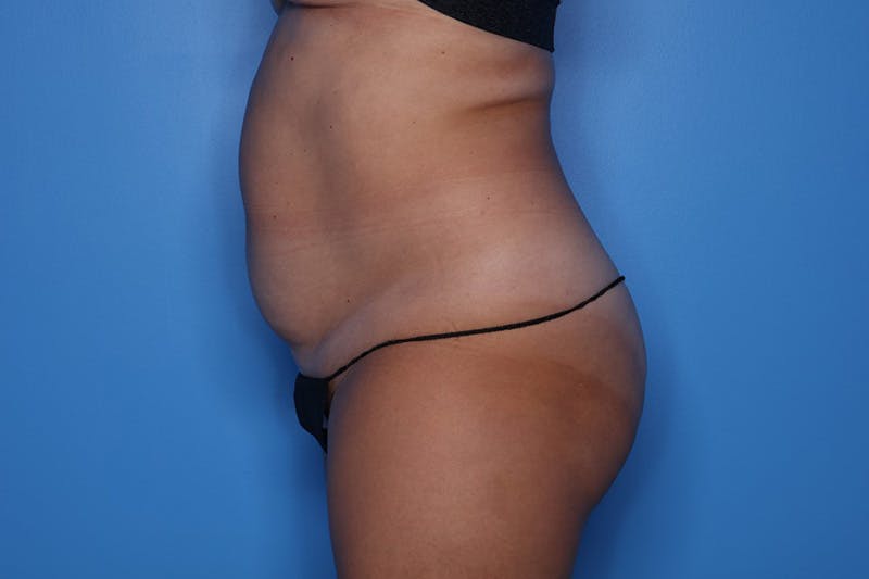 Liposuction Before & After Gallery - Patient 150098 - Image 3