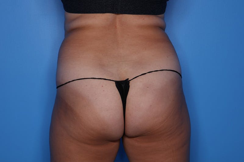 BodyTite™ Before & After Gallery - Patient 341057 - Image 5