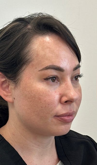 Cheek Filler Before & After Gallery - Patient 272870 - Image 1