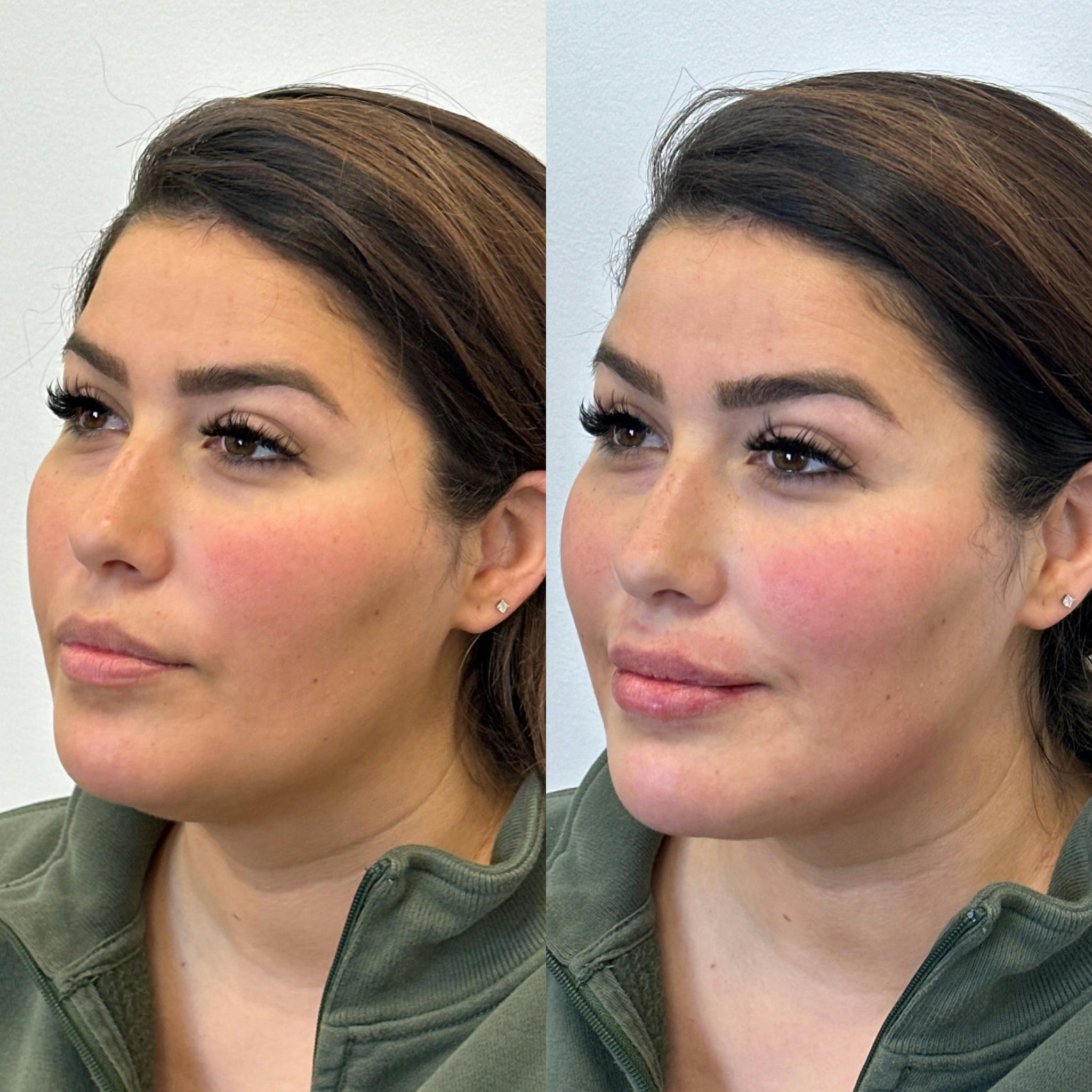 Juvéderm® Before & After Gallery - Patient 111134 - Image 2