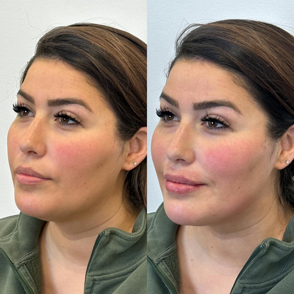 Cheek Filler Before & After Gallery - Patient 311272 - Image 2