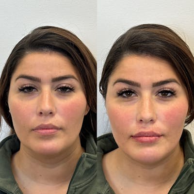Cheek Filler Before & After Gallery - Patient 311272 - Image 1