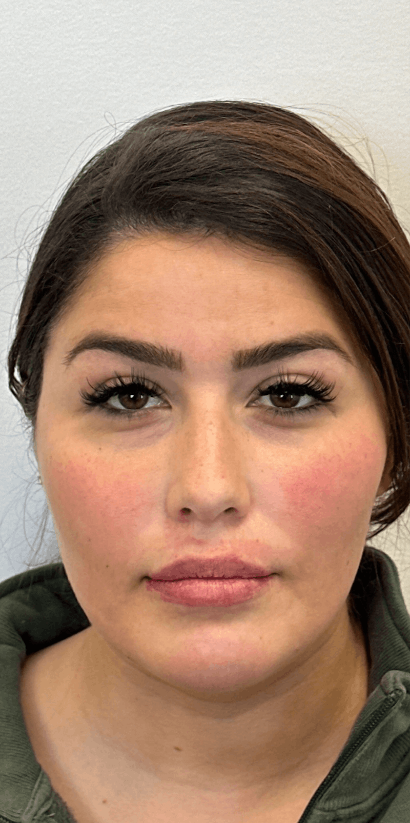 Jawline Filler Before & After Gallery - Patient 235813 - Image 2
