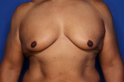 Gynecomastia (Male Breast Reduction) Before & After Gallery - Patient 175988 - Image 1