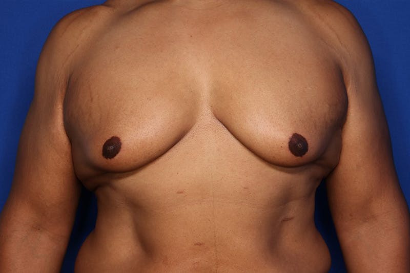 Gynecomastia (Male Breast Reduction) Before & After Gallery - Patient 175988 - Image 1