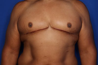 Gynecomastia (Male Breast Reduction) Before & After Gallery - Patient 175988 - Image 2