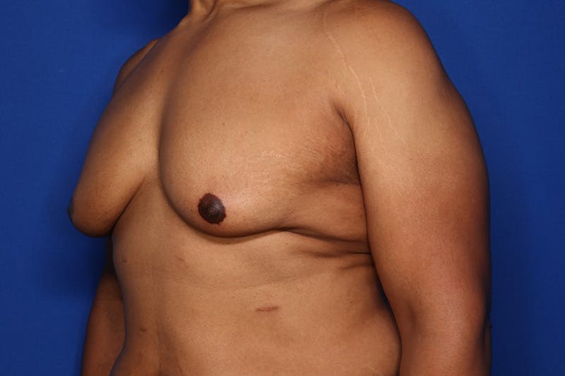 Gynecomastia (Male Breast Reduction) Before & After Gallery - Patient 175988 - Image 3