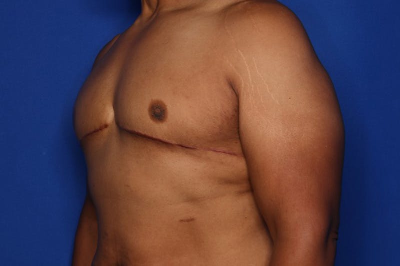 Gynecomastia (Male Breast Reduction) Before & After Gallery - Patient 175988 - Image 4