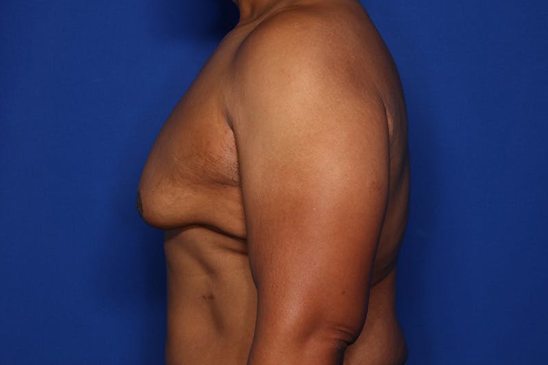 Gynecomastia (Male Breast Reduction) Before & After Gallery - Patient 175988 - Image 5