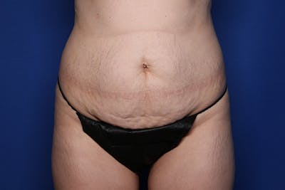 Tummy Tuck Before & After Gallery - Patient 396950 - Image 1