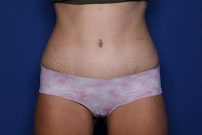 Tummy Tuck Before & After Gallery - Patient 396950 - Image 2