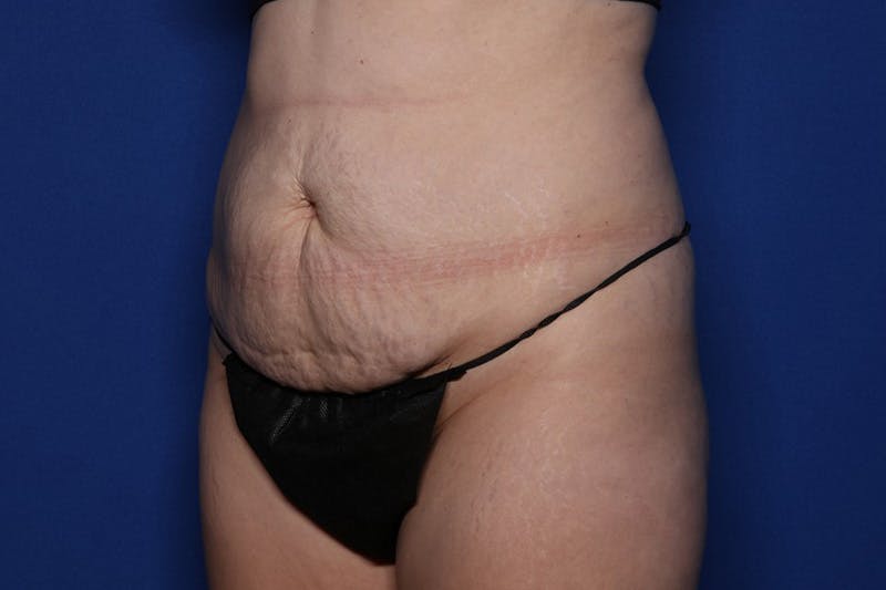 Tummy Tuck Before & After Gallery - Patient 396950 - Image 3